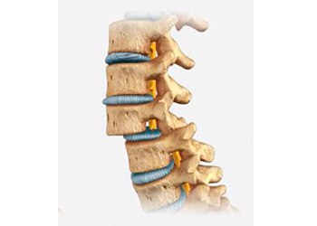 Desplazamiento de vértebra lumbar