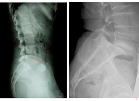 Radiografía de desplazamiento vertebral