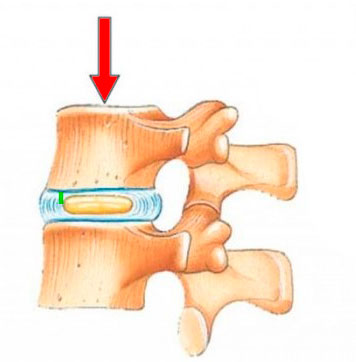 deshidratación discal