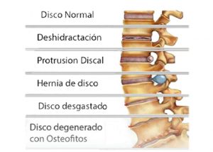 protusión disco osteofitaria